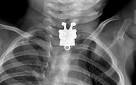 Doctors left stunned by SpongeBob SquarePants X-ray scan - Telegraph