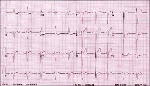 Image result for  ^ L V [ h    