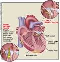 graphic of <b>mitral valve</b>