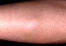 Picture 1 – <b>Angiolipoma</b>