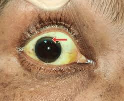 Kuvahaun tulos haulle Kayser-Fleischer