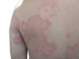 Image result for tinea corporis