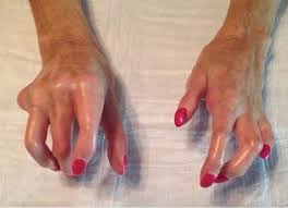 Attēlu rezultāti vaicājumam “Scleroderma”