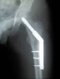 Hip fracture - Wikipedia, the free encyclopedia