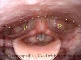 Attēlu rezultāti vaicājumam “Cribraria piriformis young”