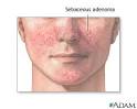 Sebaceous adenoma