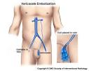 illustration of <b>varicocele</b>