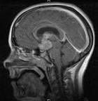 File:Tumor <b>Germinoma</b>