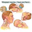 Whiplash Treatment San Diego | Whiplash San Diego | Auto Accident.