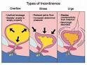 Urinary Incontinence: Causes, Symptoms and Treatment
