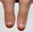 Clubbed thumb - Wikipedia, the free encyclopedia