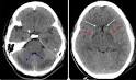 Cerebral edema - symptoms, causes, diagnosis and treatment by ...