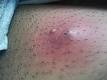 <b>Abscess</b> - Wikipedia, the free