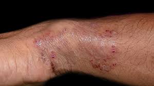 Image result for tinea corporis