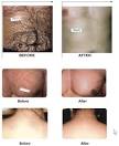 Botox Houston, Restylane , Perlane , Lipodissolve , Lipo , Houston ...
