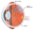 <b>Retinal Detachment</b>: What Is a Torn or <b>Detached Retina</b>? - Eye M.D.