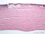 <b>Corneal Stromal</b> Dystrophies.