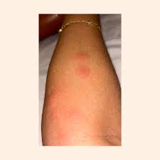 Image result for bed bug bites