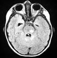 of the <b>optic nerve tumor</b>