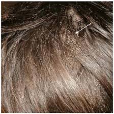 Attēlu rezultāti vaicājumam “Pediculus humanus capitis”