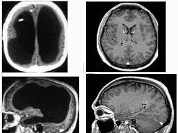 Image result for no brain