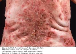 Attēlu rezultāti vaicājumam “Pemphigus borealis”