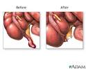 Appendectomy - series: MedlinePlus Medical Encyclopedia