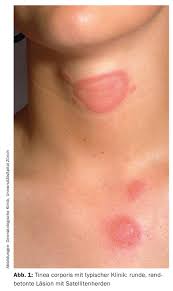 Image result for tinea corporis