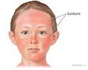 <b>Sunburn</b>