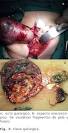 otras <b>neoplasias ováricas</b>;