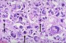 Anaplasia