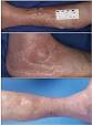 Opportunistic <b>Infections</b> Caused by <b>Serratia</b> marcescens - MicrobeWiki