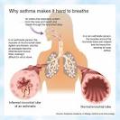 Asthma - symptoms, treatment and medications | Health Dictionary