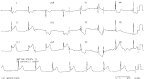 Sinus Bradycardia