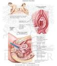 Dyspareunia: Deep Thrust - Netter Medical Images
