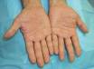 <b>Dyshidrotic eczema</b> is