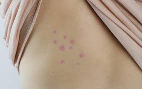 Image result for bed bug bites