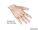 <b>Cyanosis</b> of the nail bed: