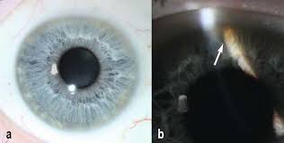 Kuvahaun tulos haulle Kayser-Fleischer