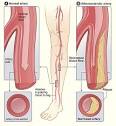 What Is Peripheral Arterial Disease? - NHLBI, NIH