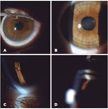 Kuvahaun tulos haulle Kayser-Fleischer