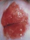 Cervical Cancer Screening - Unaided Visual Inspection of the ...