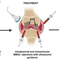 Image result for BMAC