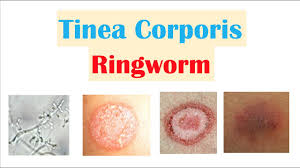 Image result for tinea corporis