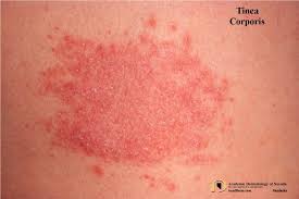 Image result for tinea corporis
