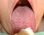 geographic <b>tongue</b>.jpg