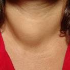 Pictures of Thyroid Nodule - Otolaryngology Houston
