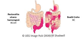 Image result for boala crohn si schizofrenie paranoida