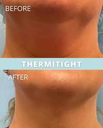 Image result for rupaljanuj