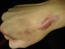 <b>Cicatrix Hypertrophy</b>